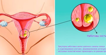 Лечение и симптомы кисты в матке