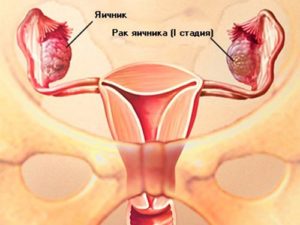 Рак придатков симптомы у женщин