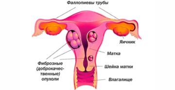 Что называют фиброзом матки