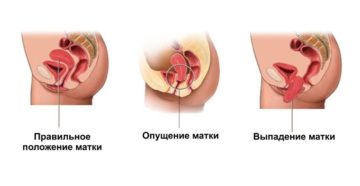 Последствия опущения матки у женщин