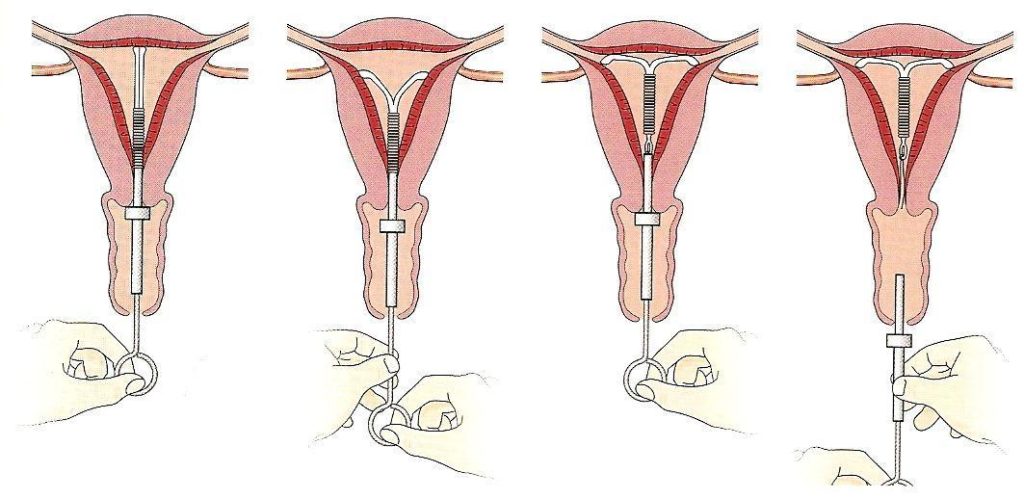 Как выбрать внутриматочную спираль