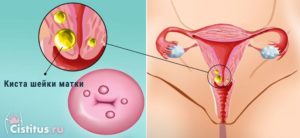 Признаки и симптомы кисты на шейке матки
