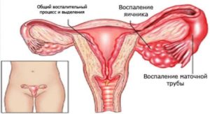 Воспалительный процесс у женщин симптомы