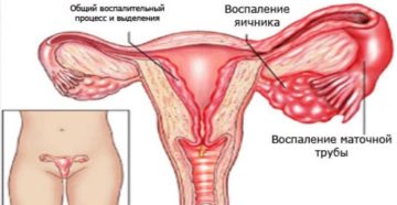 Воспалительный процесс у женщин симптомы