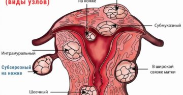 Субсерозный узел в матке