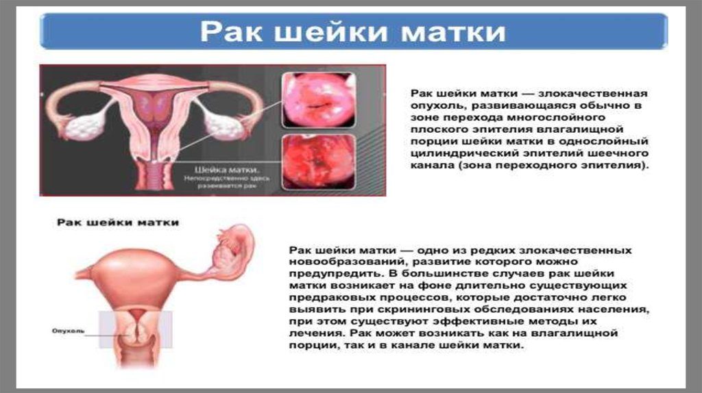 Как быстро происходит развитие рака шейки матки