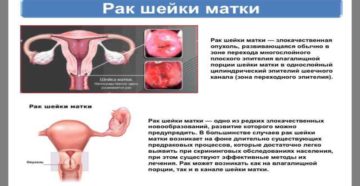 Как быстро происходит развитие рака шейки матки