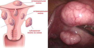 Миома матки откуда берется