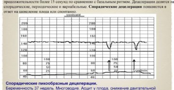 Децелерация на ктг что это