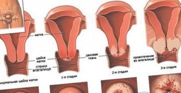 Цервикоз шейки матки