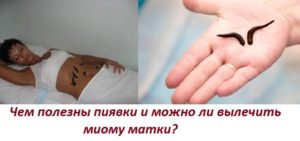 Пиявки при миоме матки