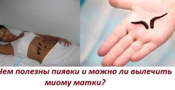 Пиявки при миоме матки