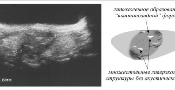 Гипоэхогенный узел в матке