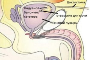 Цистостома мочевого пузыря у мужчин