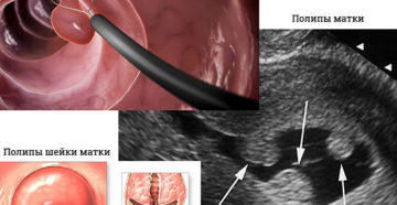 Полипы на шейке матки