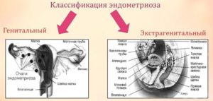 Наружный и экстрагенитальный эндометриоз