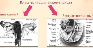 Наружный и экстрагенитальный эндометриоз