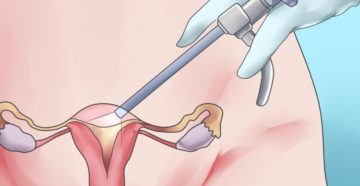 Лапароскопическое удаление матки