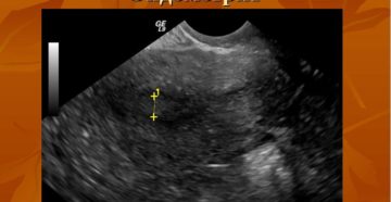 Как определить эндометрит