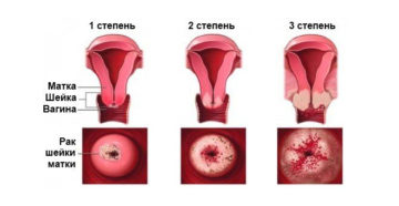 Рак ин ситу шейки матки