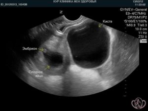 Киста яичника при беременности
