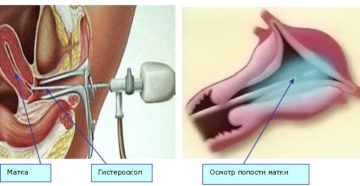 Чистка матки при эндометриозе