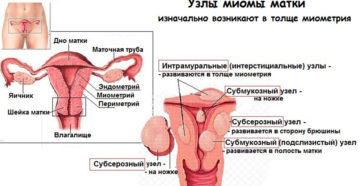 Узелки в матке