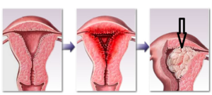 Причины утолщения эндометрия матки