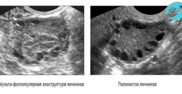 Обеднение фолликулярного аппарата яичников что это такое