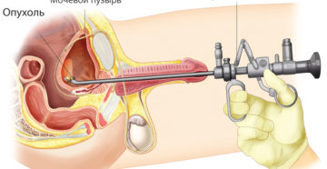 Биопсия мочевого пузыря у мужчин