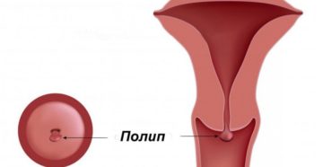 Что такое полип шейки матки