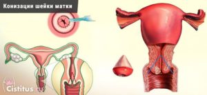 Лечение после конизации шейки матки