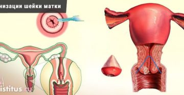 Лечение после конизации шейки матки