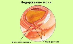 Слабость мочевого пузыря у женщин лечение