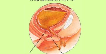 Слабость мочевого пузыря у женщин лечение