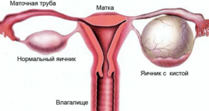 Увеличенные яичники у женщин причины