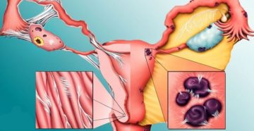 Эндометриоидные гетеротопии что это такое