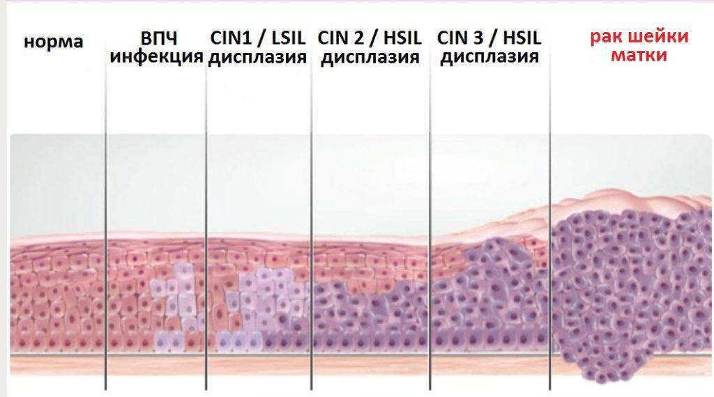 Cin 1 2 степени что это