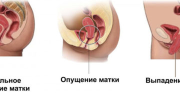 Как лечить опущение и выпадение матки и шейки