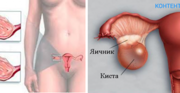 Киста (правого, левого) яичника:  лечение, последствия, фото