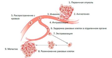 Что такое инвазия в онкологии