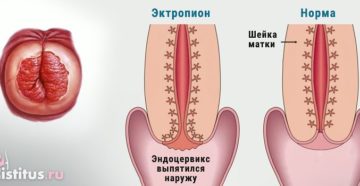 Эрозированный эктропион шейки матки