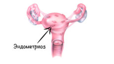 Что такое эндометриоз и чем он опасен