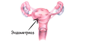 Что такое эндометриоз и чем он опасен