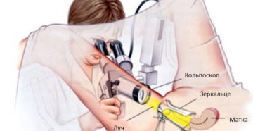 Осмотр шейки матки под микроскопом