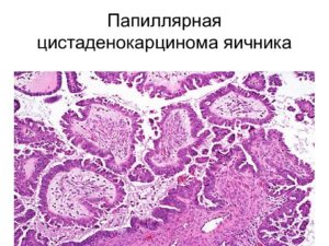 Муцинозная и серозная папиллярная цистаденокарцинома яичника