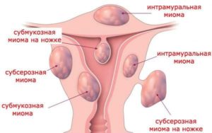 Лечение узловой миомы матки народными средствами