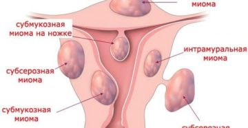 Лечение узловой миомы матки народными средствами