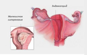 Что такое железистая гиперплазия эндометрия