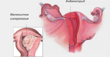 Что такое железистая гиперплазия эндометрия